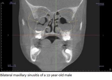 bilateral maxilliar sinusitis of a 12 year old male